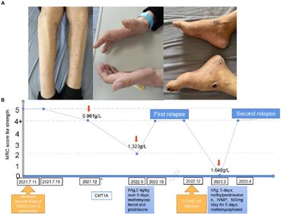 Case report: Chronic inflammatory demyelinating polyneuropathy superimposed on Charcot–Marie-tooth type 1A disease after SARS-CoV-2 vaccination and COVID-19 infection